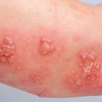 ویژگی‌های خاص واکسن زونا